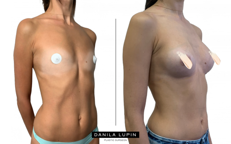 Увеличение груди фото до и после операции