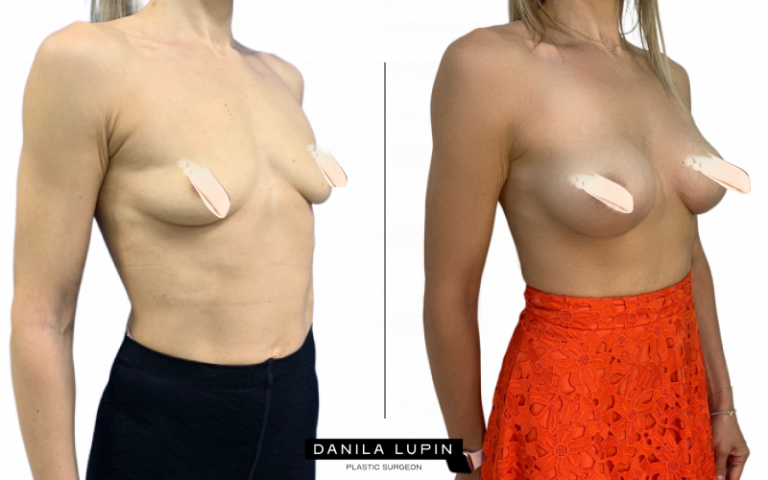 Увеличение груди фото до и после операции